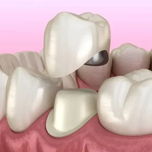 Dental Crown Problems: Causes, Fixes, and Prevention