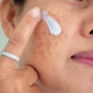 762: Hyperpigmentation: Best Practices for Best Skin