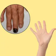 Móng tay màu đen như tụ máu là dấu hiệu của bệnh gì, có nguy hiểm?