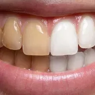 Teeth Whitening Dentist Tips for Long-Lasting Results