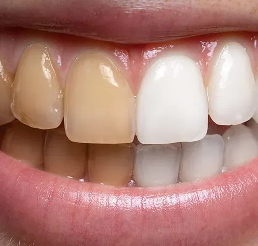 Teeth Whitening Dentist Tips for Long-Lasting Results