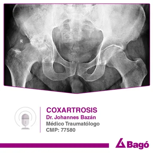 Coxartrosis: una enfermedad degenerativa
