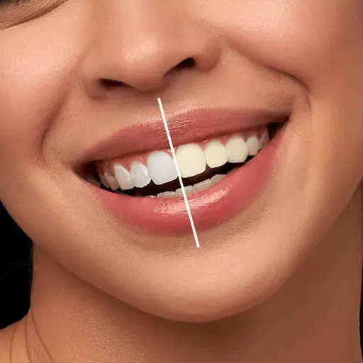 Teeth Whitening and Sensitivity: How to Protect Enamel