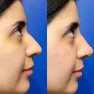 769: The Natural Look: Rhinoplasty Requests and Trends