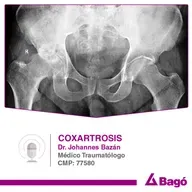Coxartrosis: una enfermedad degenerativa