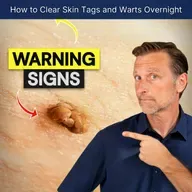 How to Clear Skin Tags and Warts Overnight