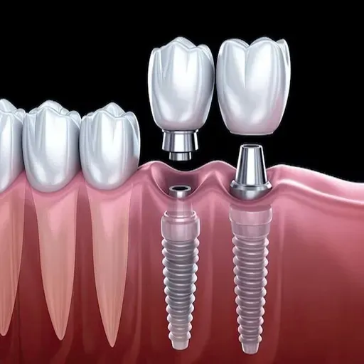 Dental Implants: Are They Right for You?